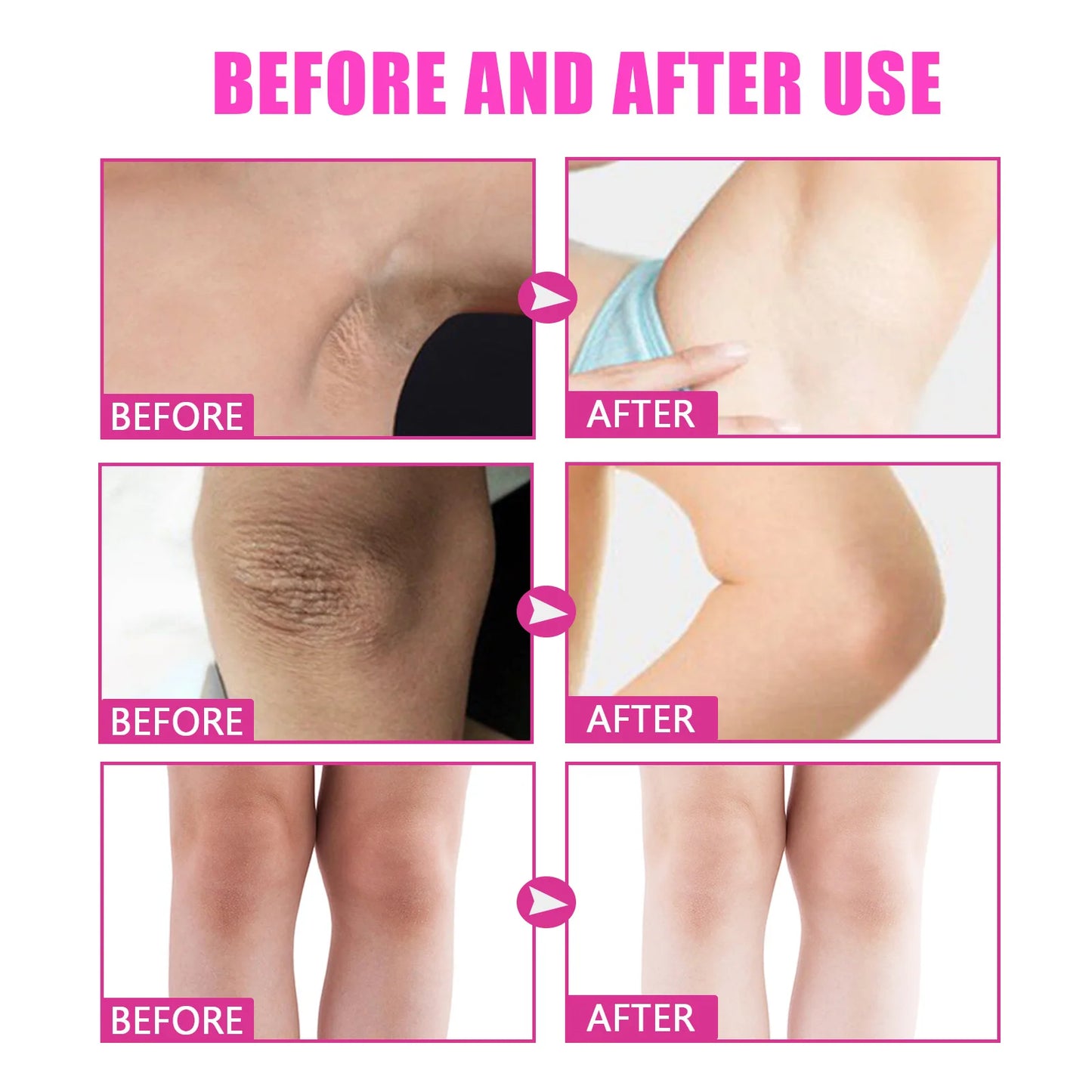 Creme Clareador Corporal | Para Joelhos, Virilha, Axilas e Zonas Íntimas