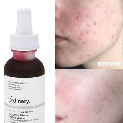 Peeling Facial AHA 30% + BHA 2% 30ml | Esfoliante, Iluminador e Anti-Imperfeições